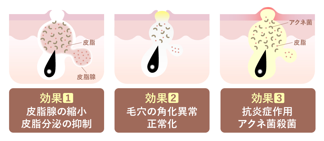 イソトレチノインの効果