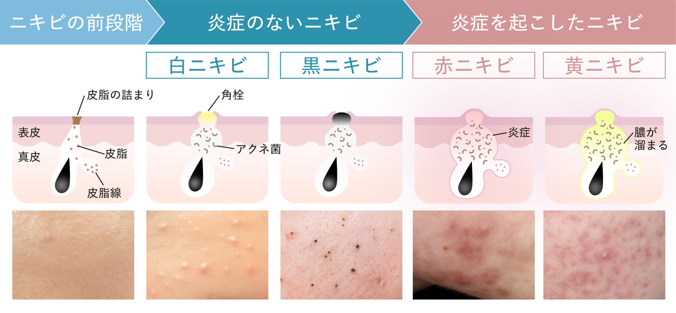 ニキビの種類と進行状況