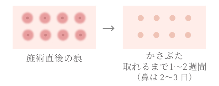 CO2フラクショナルの術後の痕