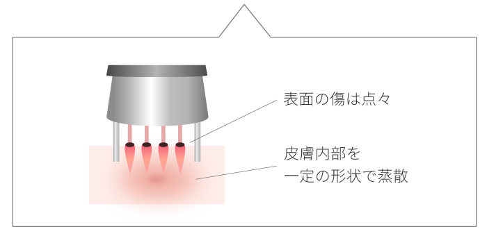 CO2フラクショナルレーザーのメカニズム