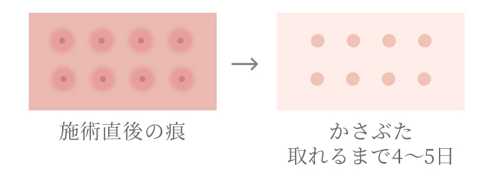 RFフラクショナルの施術の痕