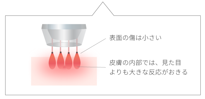 RFフラクショナルレーザーのメカニズム