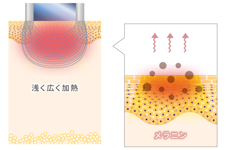 IPL光治療のメカニズム