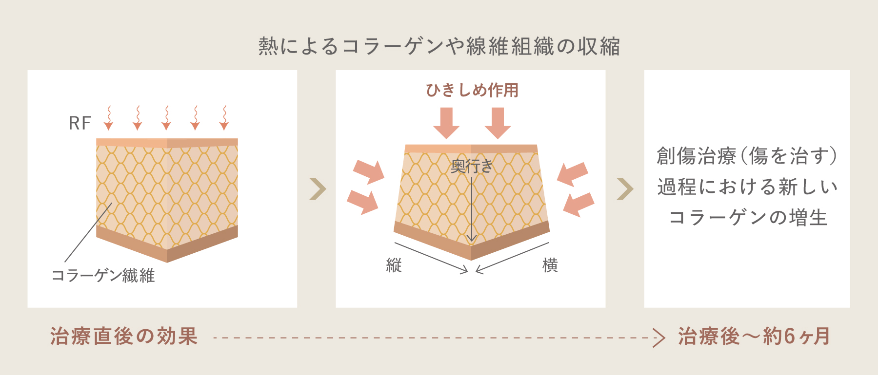 熱によるコラーゲンや線維組織の収縮のイメージイラスト