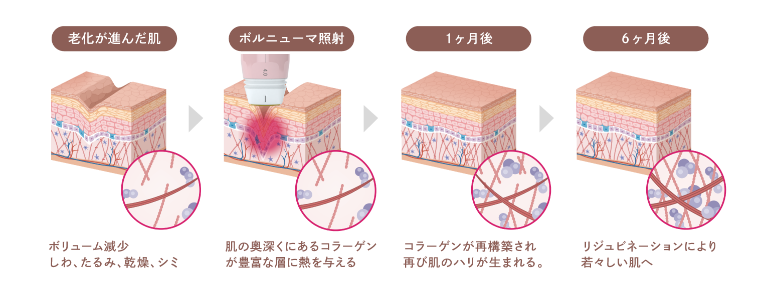ボルニューマの仕組み