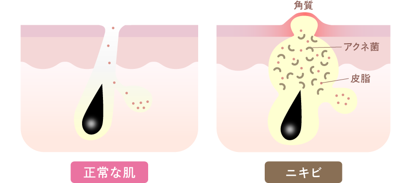 ニキビの原因