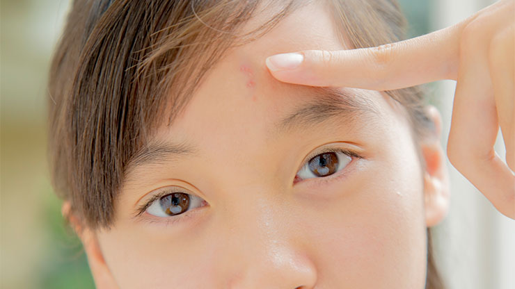 小学生のニキビ
