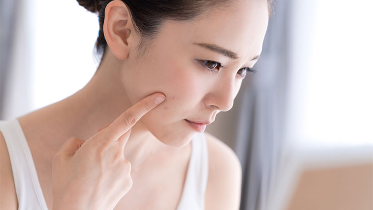 黄ニキビに悩む女性