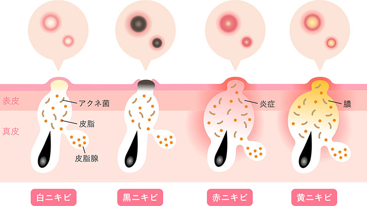 ニキビの種類と進行