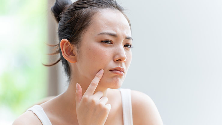 白ニキビに悩む女性