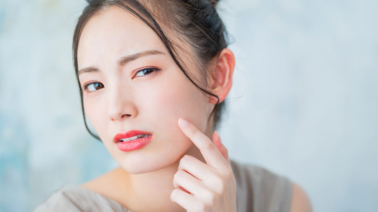 ニキビに悩んでいる女性