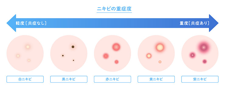 ニキビの種類と重症度