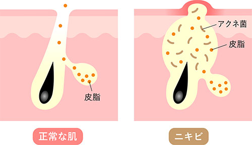 正常な肌とニキビ肌