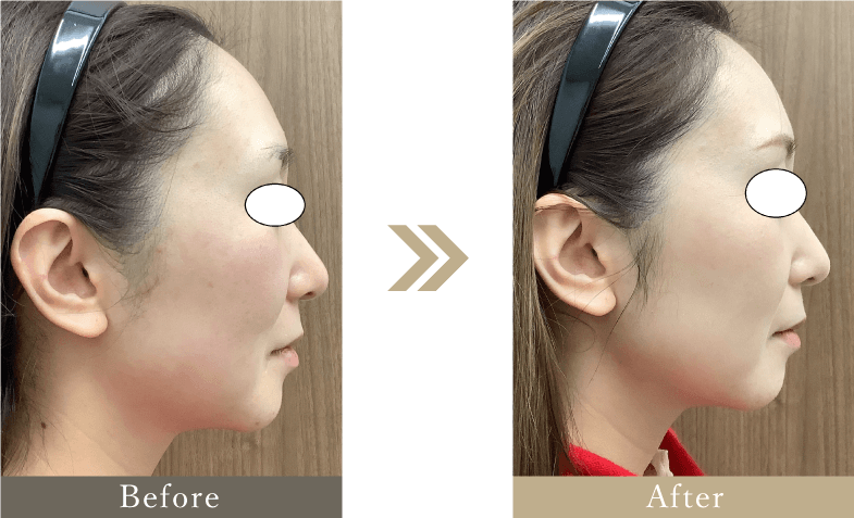 30代 フェイスラインのたるみ