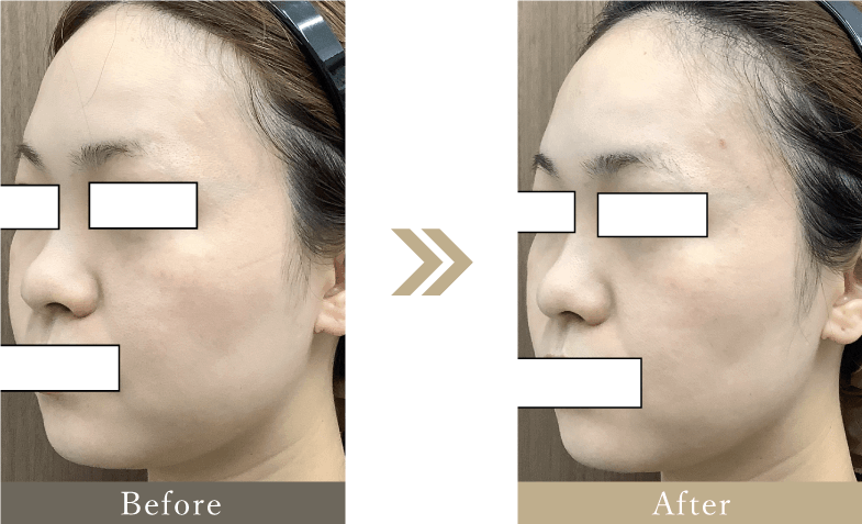 30代 フェイスラインのたるみ