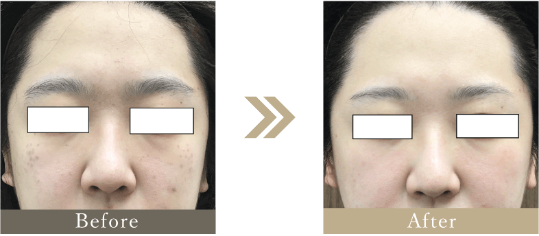 30代 ADM