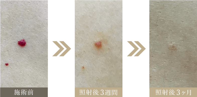40代 老人性血管腫