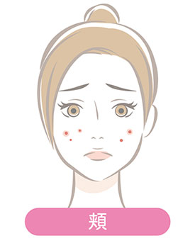 頬のニキビ