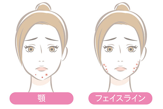 あご・フェイスラインのニキビ