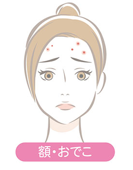おでこ・額のニキビ
