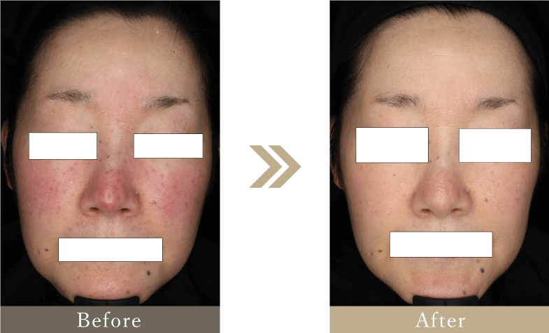 50代 酒さ・赤ら顔の症例画像