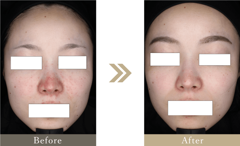 20代 酒さ・赤ら顔の症例画像